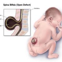 spina bifida wikimedia