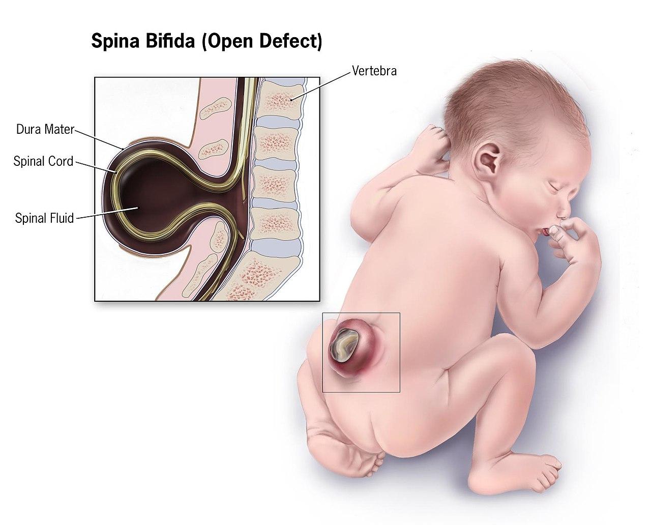 spina bifida wikimedia